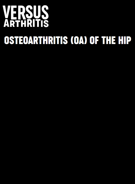 Osteoarthritis – Hip