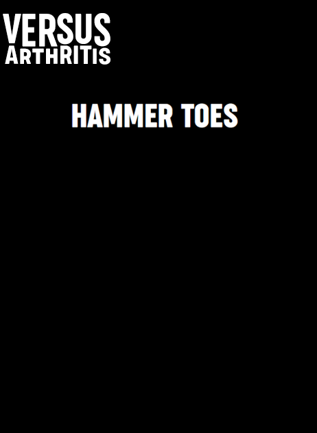 Hammer Toes