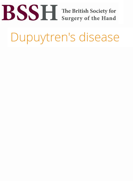 Dupuytren’s Disease